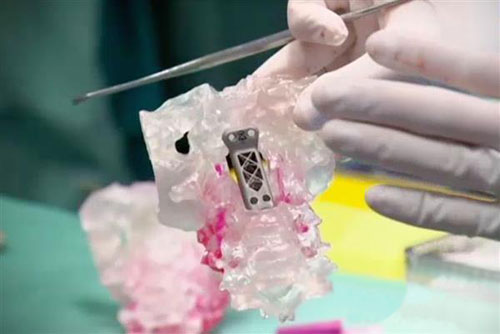 3D打印助澳洲医生完成“换头”手术